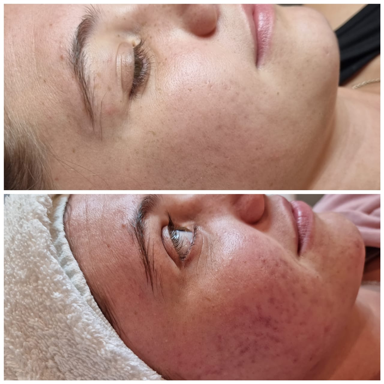 Teen / Tween facial