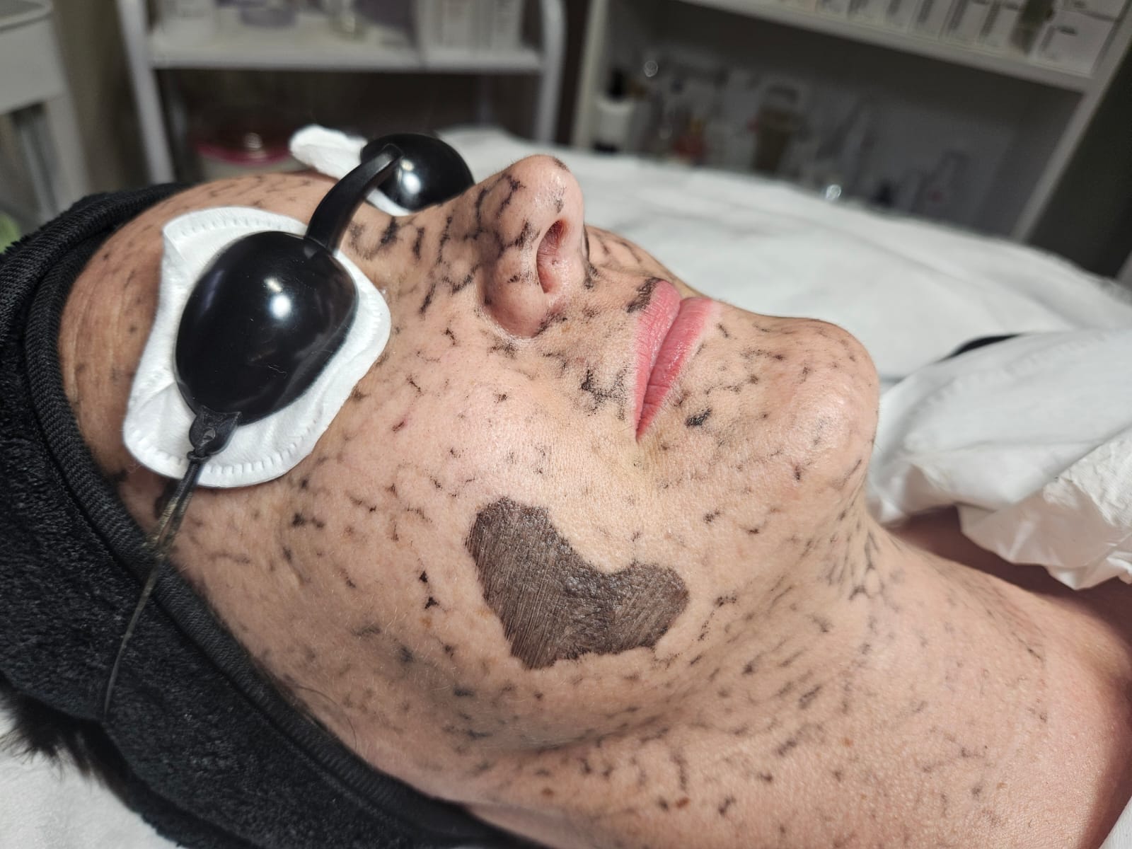 Black Carbon Facials