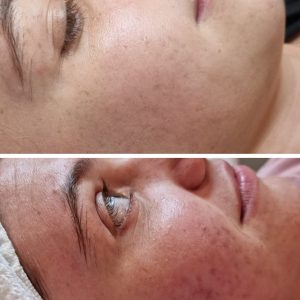 Microneedling