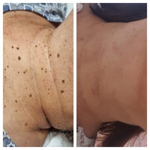 Skin tag removal