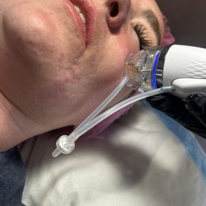 RF Microneedling