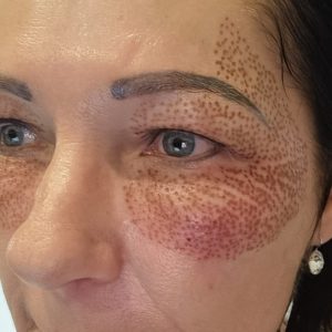 Skin tightening