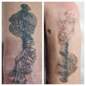 Tattoo removal
